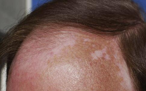 黑色素代谢反常引发白癜风