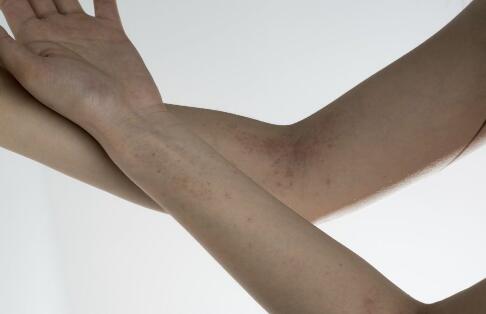 惊！精力要素竟能导致斑秃