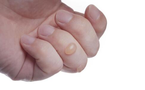 你听说过头皮型银屑病吗?