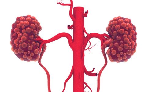 中年男性防备肾结石少喝冰红茶