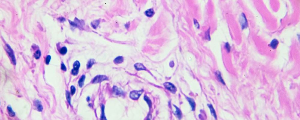 抗癌果蔬首选南瓜