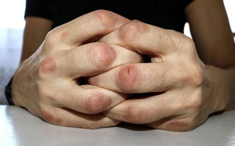 鱼鳞病前期症状都有哪些呢