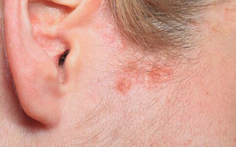 初夏脚气来袭 引荐医治脚气偏方