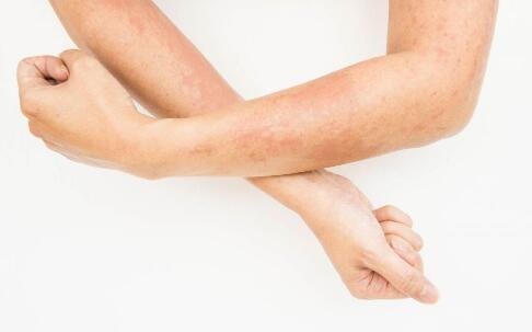 初夏脚气来袭 引荐医治脚气偏方