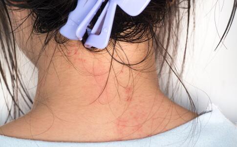 夏天防备脚气的四大忌讳