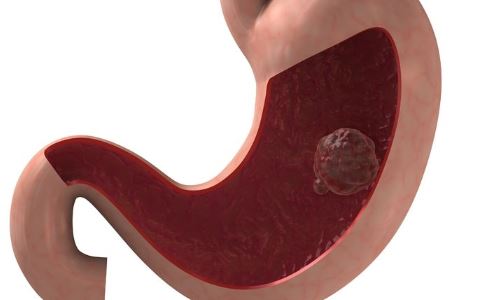 胃癌患者的饮食宜忌