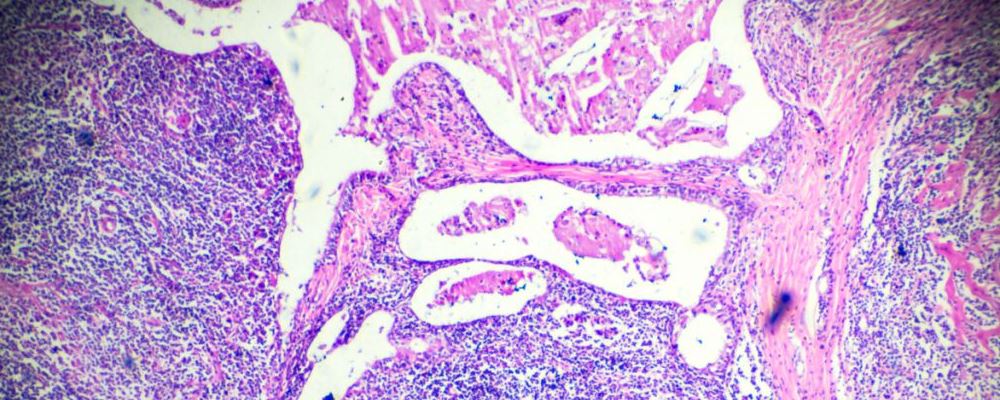 抗癌中草药干姜的成效
