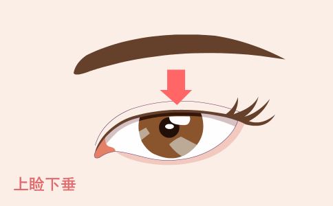 激光治疗痤疮的副作用