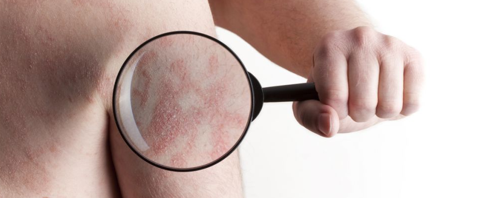 皮肤过敏要怎么辨认 皮肤过敏怎么办