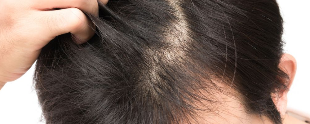 男人脂溢性脱发是怎样回事 要怎样应对