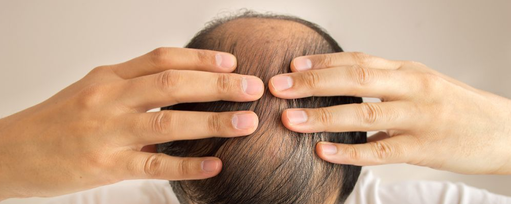 为什么秃顶的总是男人 怎么重拾颜值自傲