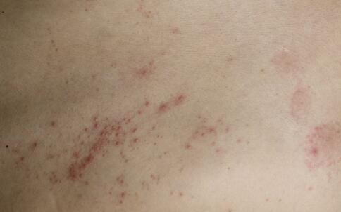 大热天冲澡不易过勤 防止患上湿疹