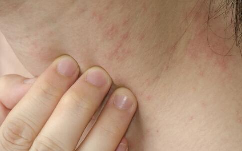 疾病百科 告知你什么是夏日皮炎