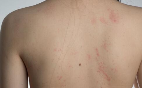 皮肤病“秋老虎”损害知多少