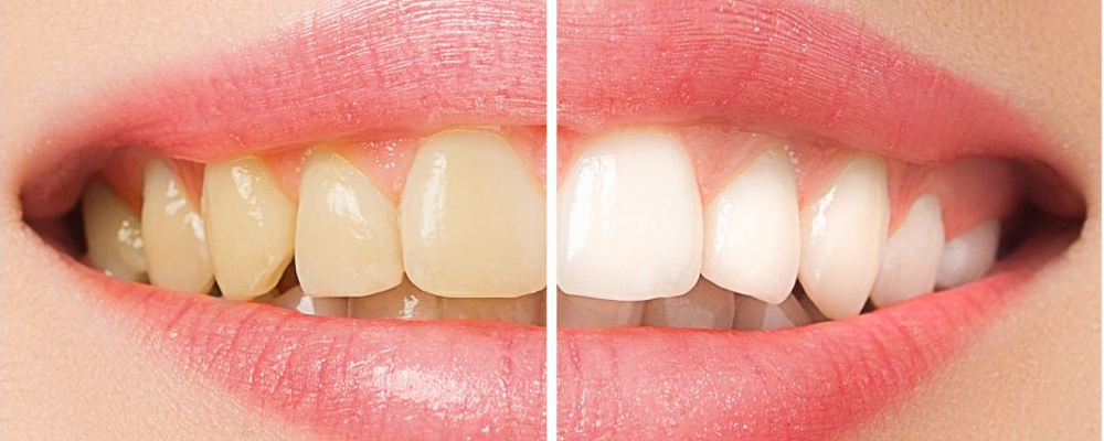 保定金属烤瓷牙套医院排行榜前十名