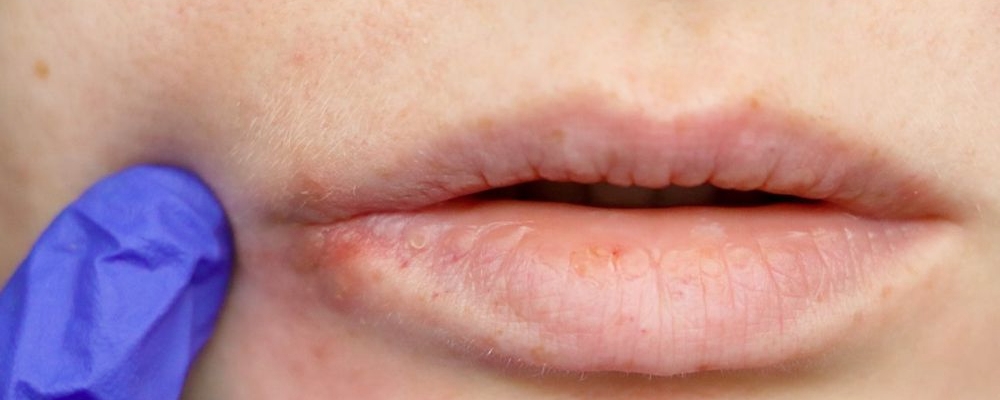 肝脏欠好,嘴唇先知,嘴部呈现4个现象警觉肝脏问题!