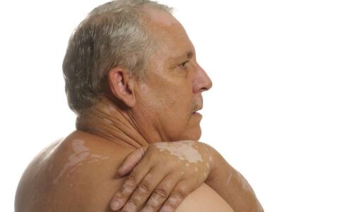 白癜风的前期症状有哪些