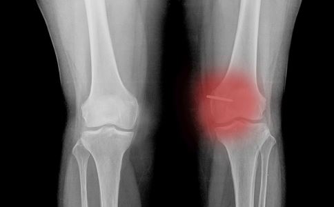 闪腰莫粗心 腰椎关节错位费事大