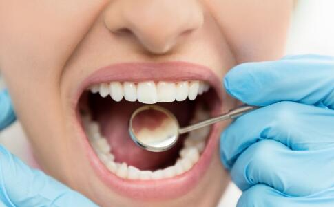 常见的四种牙套品种