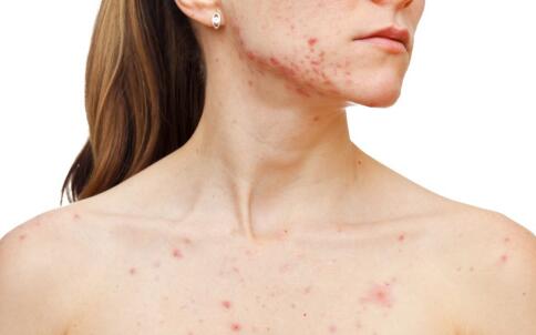 冬季常见的几种皮肤病