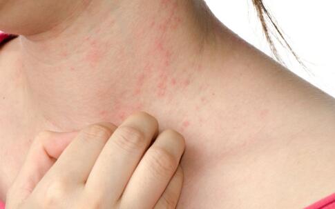 脸上长时间长痘痘该吃什么